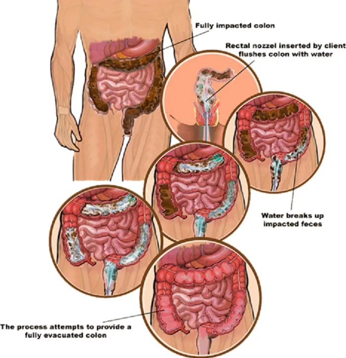 How to clean colon and intestines naturally?